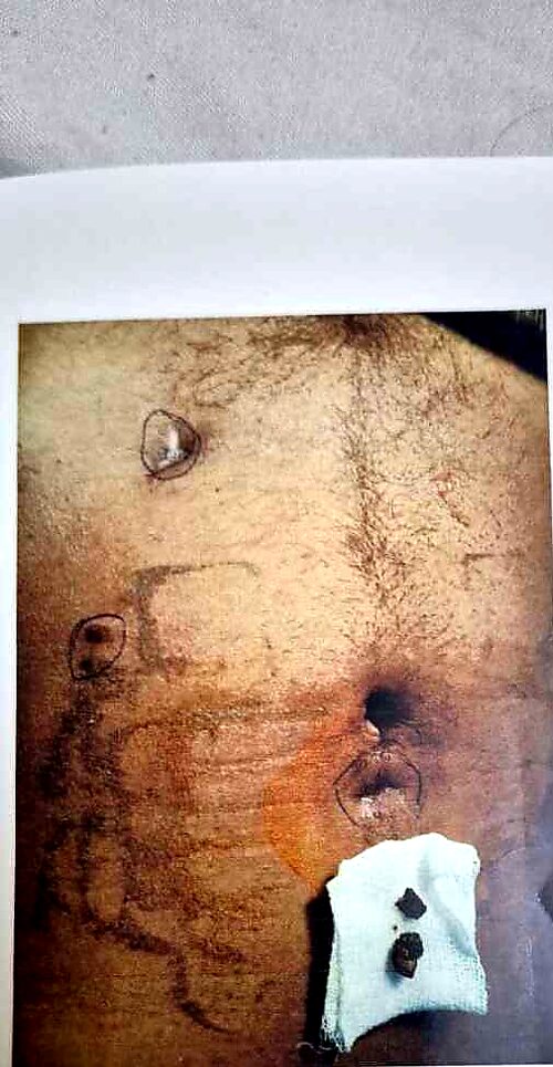 Completely healed port-site sinus following retrieval of the implanted stones