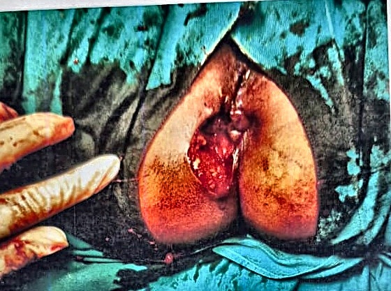 Intra-operative view following wide and complete excision of the swelling and fistulous tracts