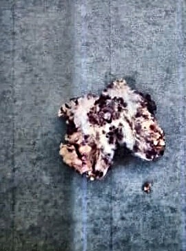 Gross specimen of the excised lesion, subsequently confirmed as endometriosis on histopathology